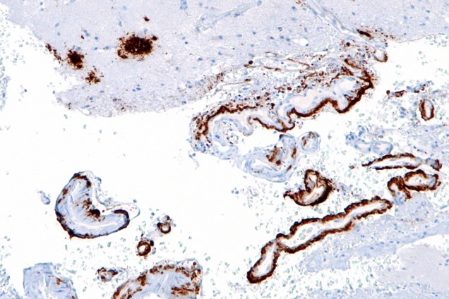 Cerebral_amyloid_angiopathy_-2b-_amyloid_beta_-_intermed_mag_-_cropped