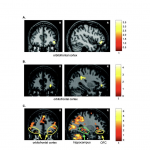 Hippocampus, Orbitofrontal Cortex, and Working Memory Study