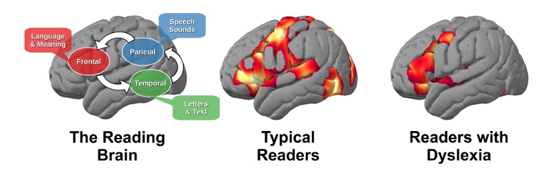 Image result for dyslexia and the brain