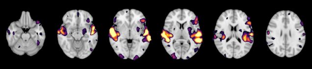 Brain slices showing speech activation
