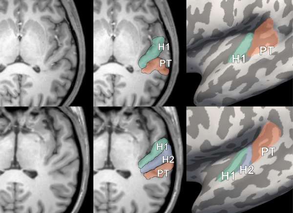 Brian scans showing single or reduplicated Heschl's gyrus.