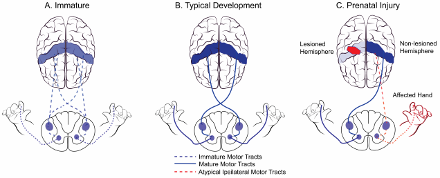Atypical brain development model