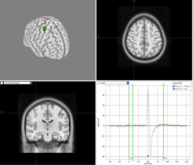 screenshot of brain and motor evoked potential data analysis