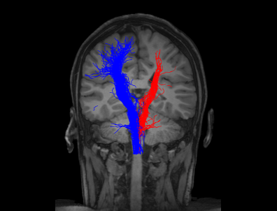 Diffusion tensor imaging scan showing white matter pathways